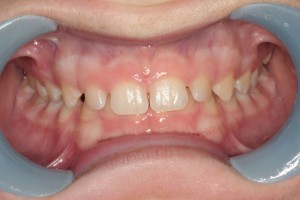 Before Full Orthodontic Treatment