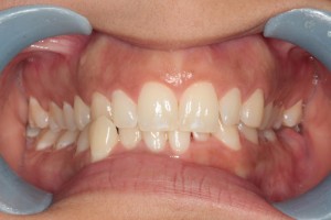 Before Full Orthodontic Treatment