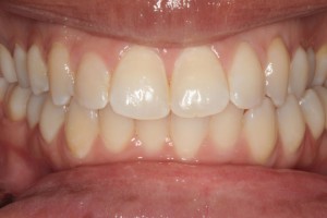 Before Invisalign Treatment