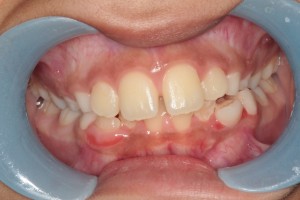 Before Phase I Orthodontic Treatment