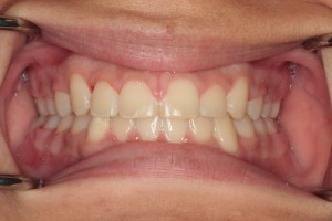 After Full Orthodontic Treatment