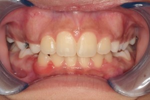 After Phase I Orthodontic Treatment