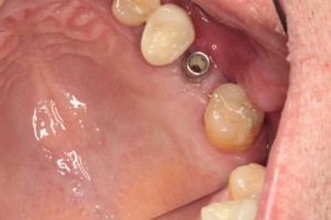 Sinus Lift and Single Implant